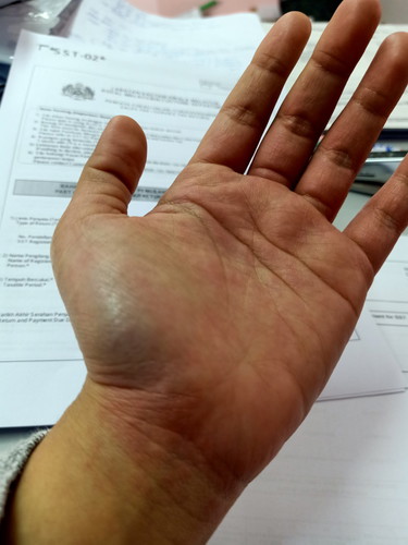 palmar erythema