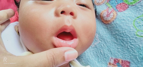 bercak putih?