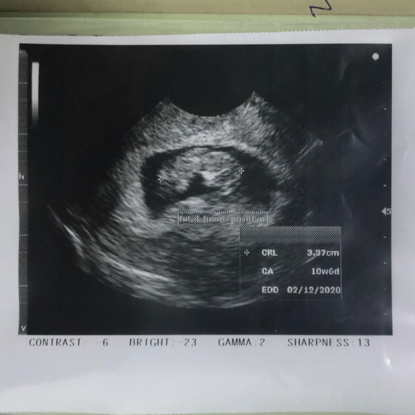 ภาวะแท้งคุกคาม