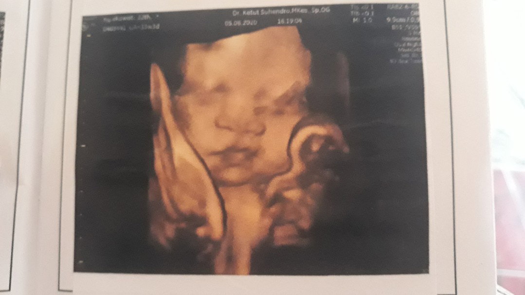 Posisi Bayi Melintang