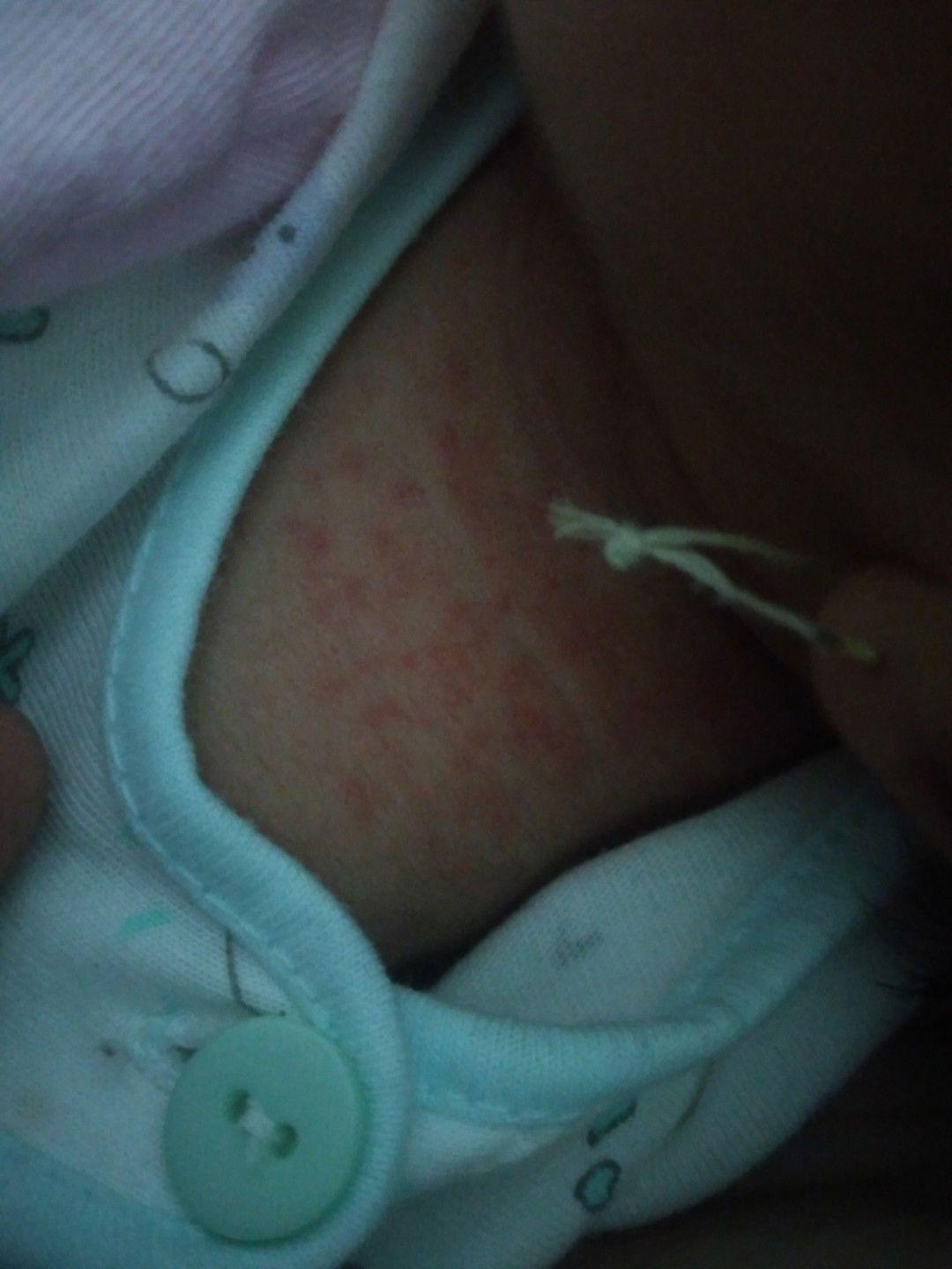 bé bị nổi mụn đỏ