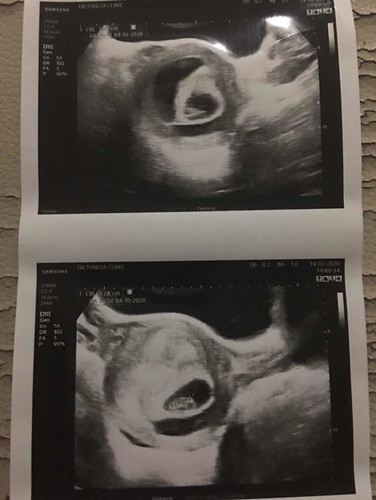 7week รกลอกตัว