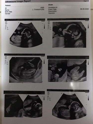 18 week
