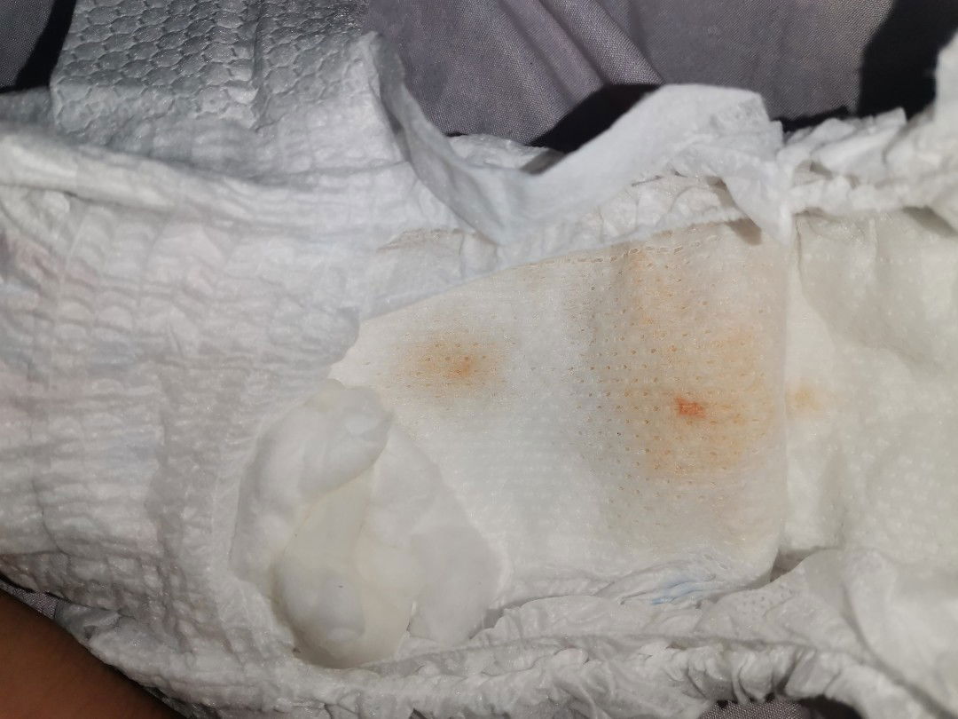 Normal Po Ba Ito Sa Baby Girl?