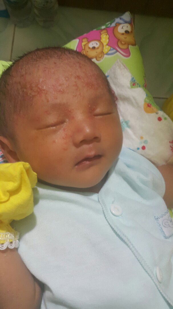 alergi atau biang keringat ya?