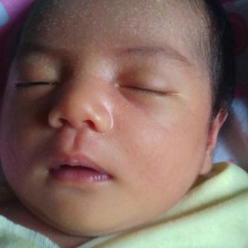 Biang Keringat Di Dahi