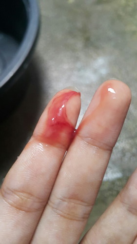 เช้านี้มีเลือดแบบนี้ออกมา!!