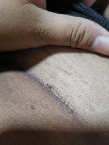 เเผลผ่าคลอดเเสบ??