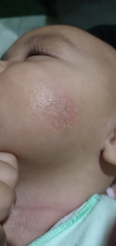 Pipi bayi kemerahan