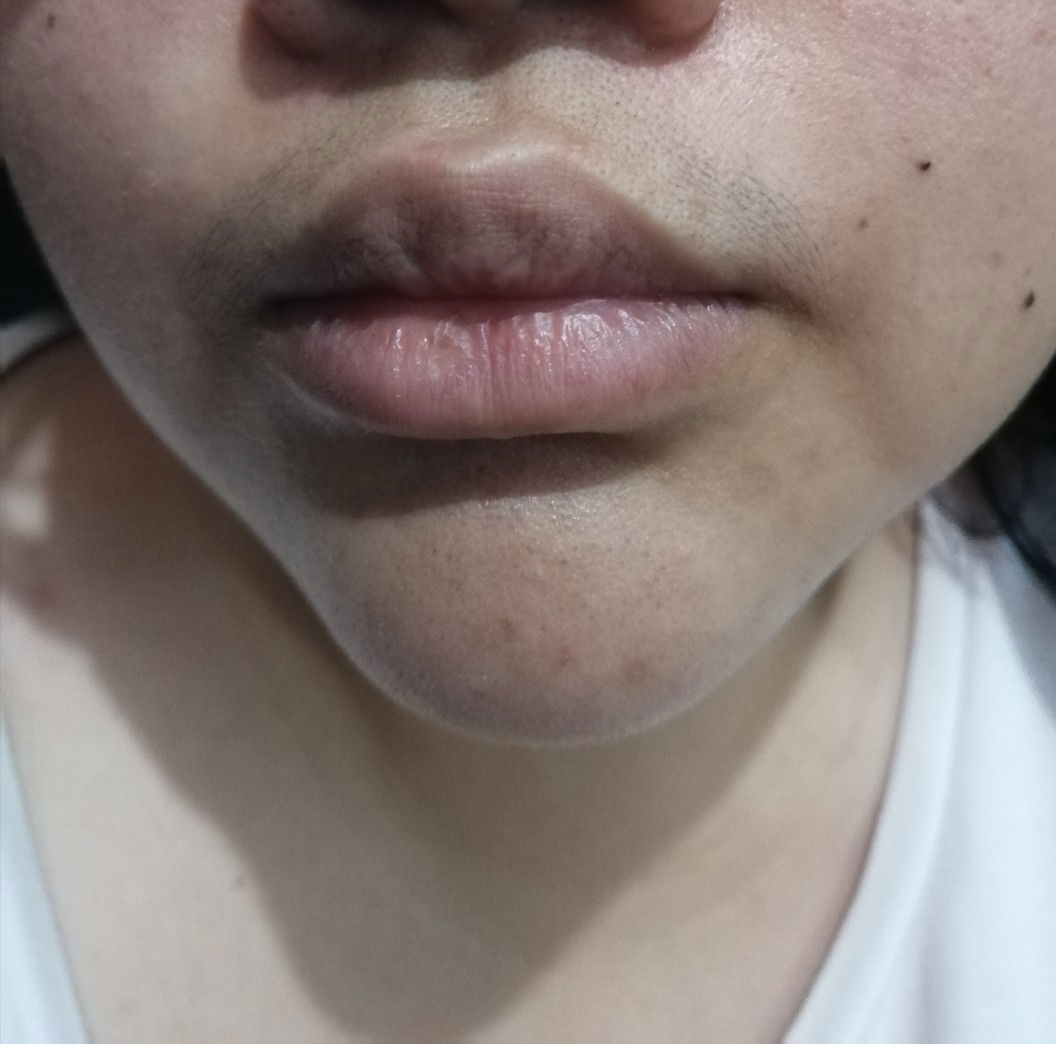 FACIAL HAIR DURING PREGNANCY