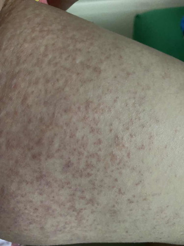 37 วีค ผดขึ้น ต้องทำยังไงดีคะ
