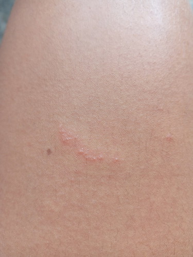 #คันมากก