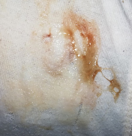 Discharge... (Sorry for the photo)