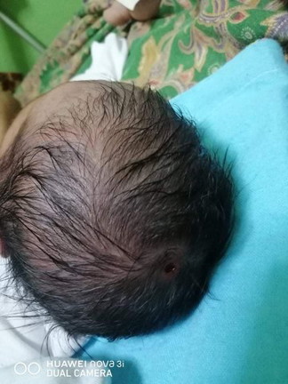 Sugat sa ulo ni baby