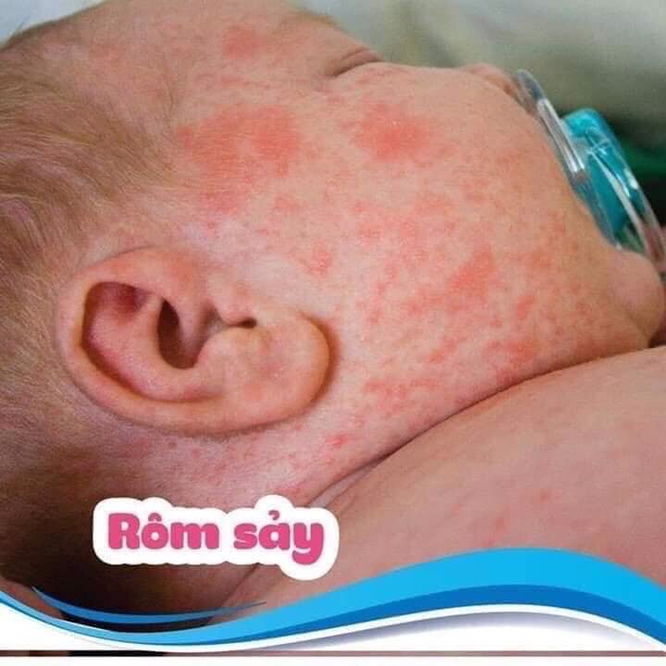 ?? #MẸ_NÀO_CÓ_CON_NHỎ_ĐANG_MẮC #CÁC_BỆNH_DA_LIỄU_NGOÀI_DA_NHƯ : ? Rôm sảy ? Nấm Da Đầu, Nấm Móng Tay Chân ? Côn Trùng Đốt ? Viêm Da Do Tiếp Xúc, Do Tả Lót ? Chóc lở ? Chàm ? Hắc Lào, Lang Ben ? Mẩm Ngứa, Ghẻ ? Viêm Da Cơ Địa....  ✉#INBOX ngay để được tv ạ