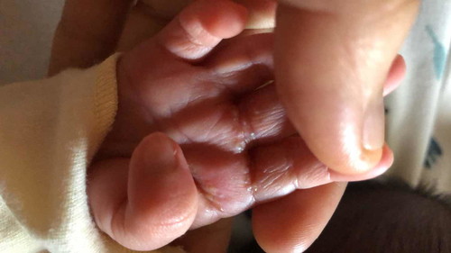 Bintik putih ditangan