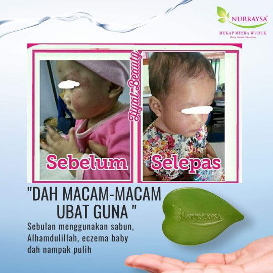 Anak ada ruam dan ezcema ?