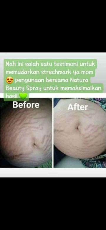 Streckmark,ruam asi,bintik merah bayi baru lahir,selengkangan hitam