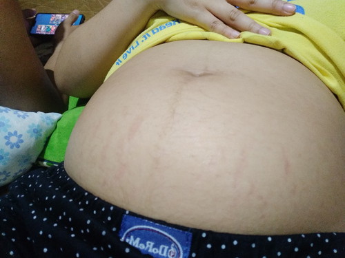 Stretchmark