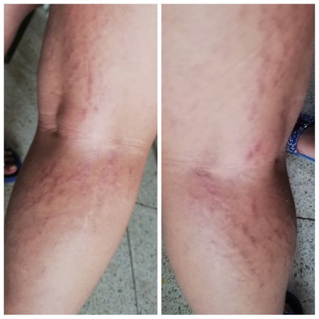 Red stretch marks