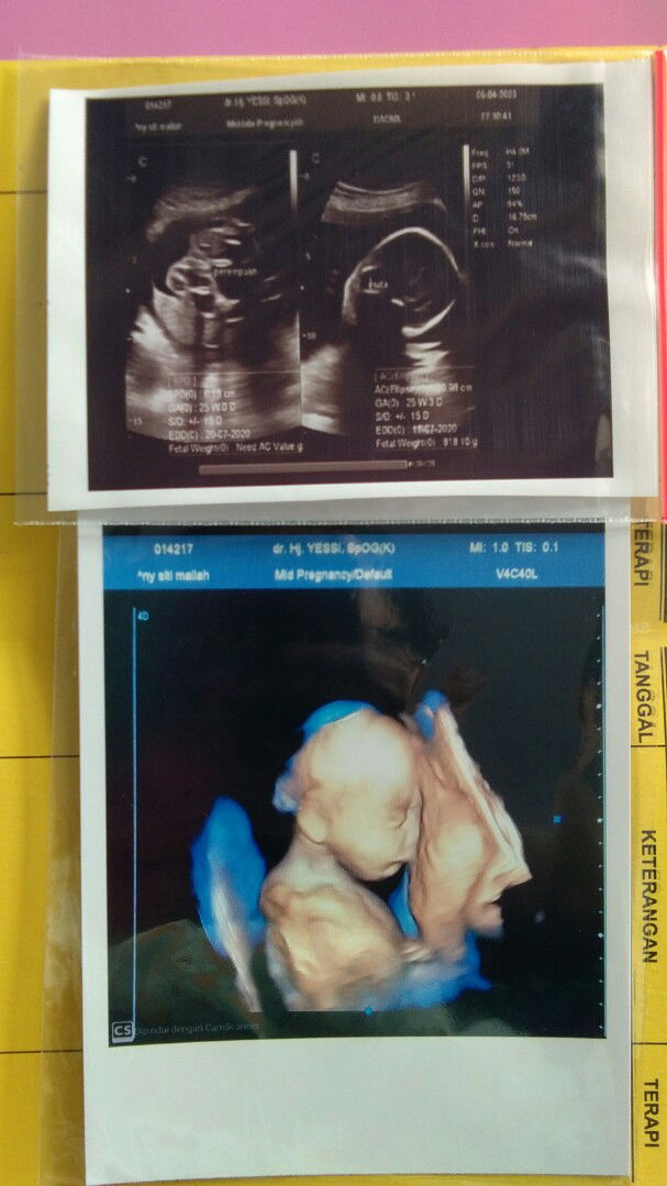 USG ke 2 di UK 25w -> mengagetkan ?