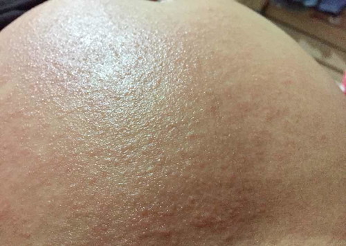 ท้องได้ 19W ค่ะ อยู่ดีๆ ก็เป็นผื่นที่หน้าท้อง