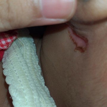 cara mengobati luka d kulit bayi