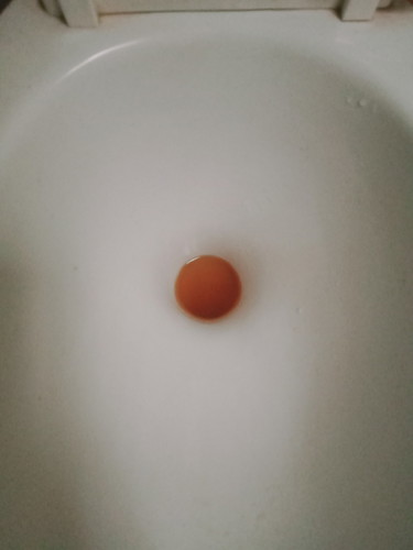 ปัสสาวะสีเข้ม