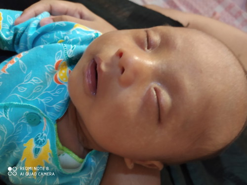 Bintik putih pada wajah bayi