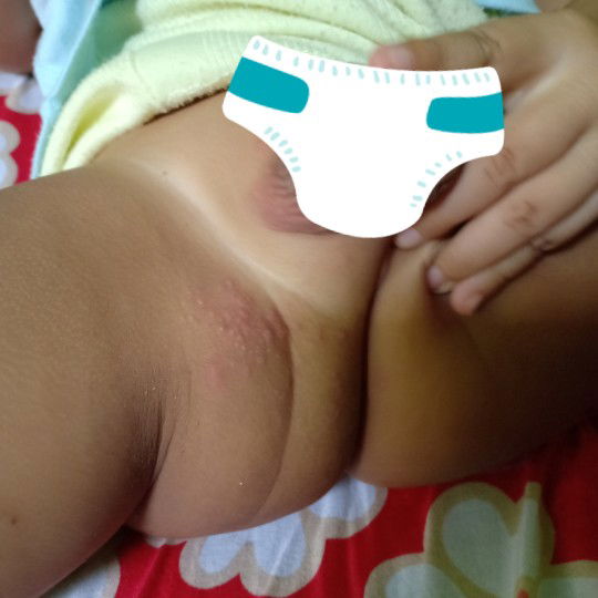 selangkangan bruntusa