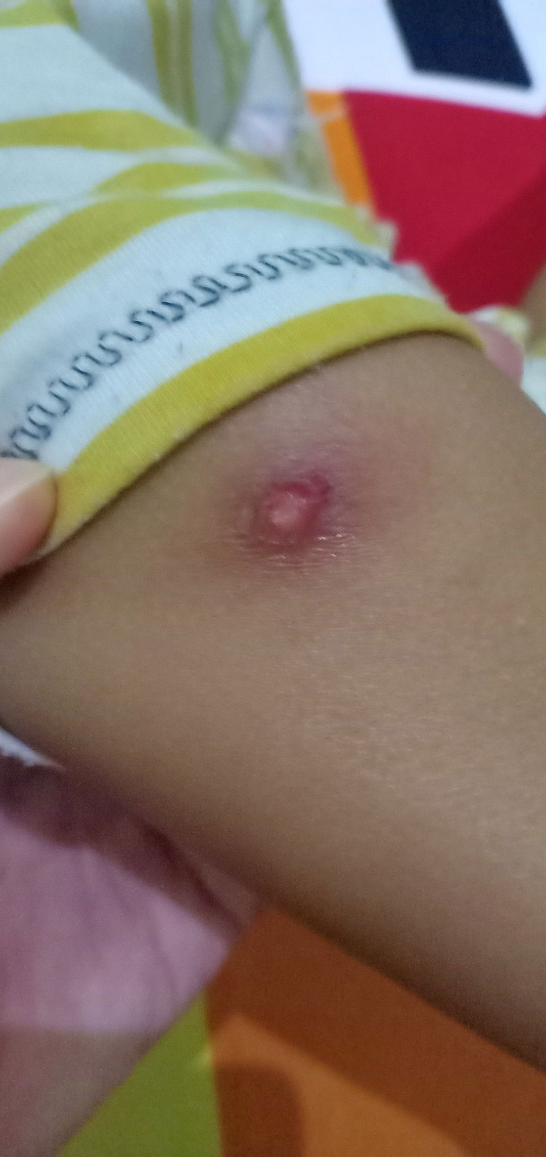 luka gatal di kaki anak