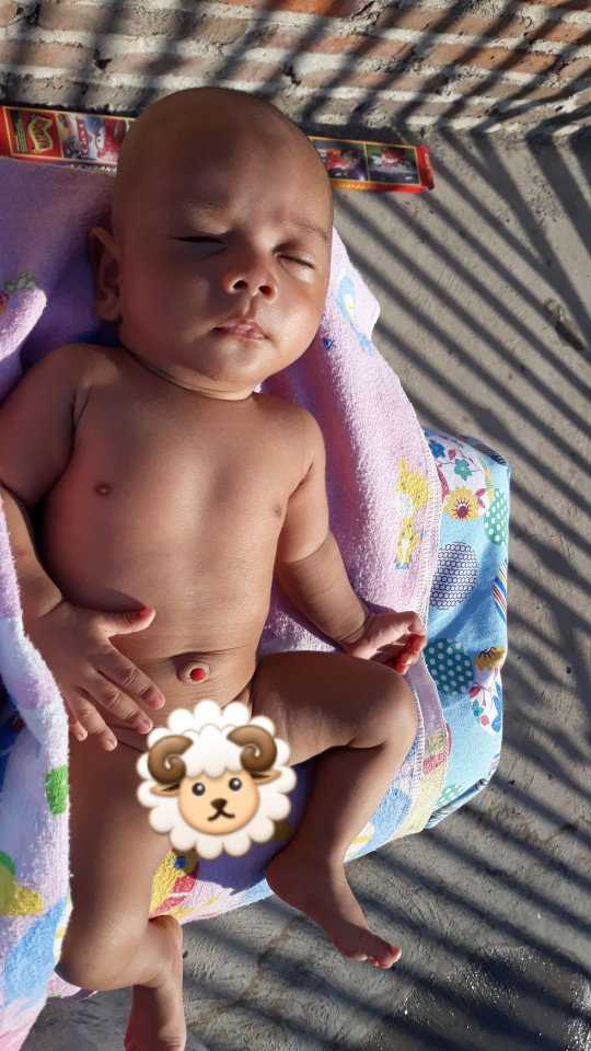 Baby granuloma umbilical?