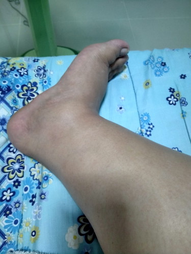 เท้าบวม