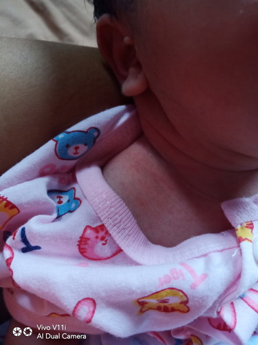 เปนผื่นขึ้น