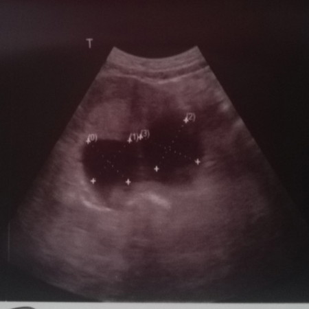 cyst