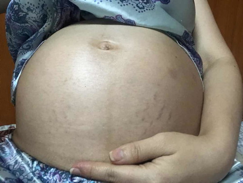 รอยแตกลาย มันมาแล้ว!!