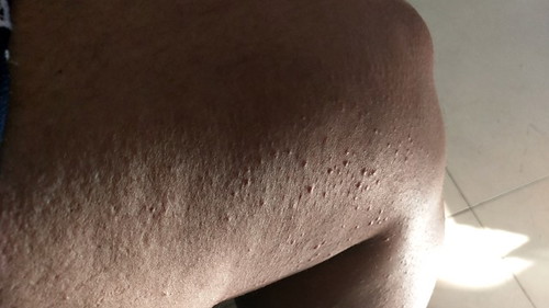 อายุครรภ์ 37 สัปดาห์ค่ะ ช่วงนี้ มีอาการคันตามตัว และขา ผื่นขึ้นค่ะ เบื้องต้นใช้คารามายด์บรรเทาอาการค่ะ อยากทราบว่า อาการแบบนี้เป็นอาการปกติของคุณแม่ไหมคะ