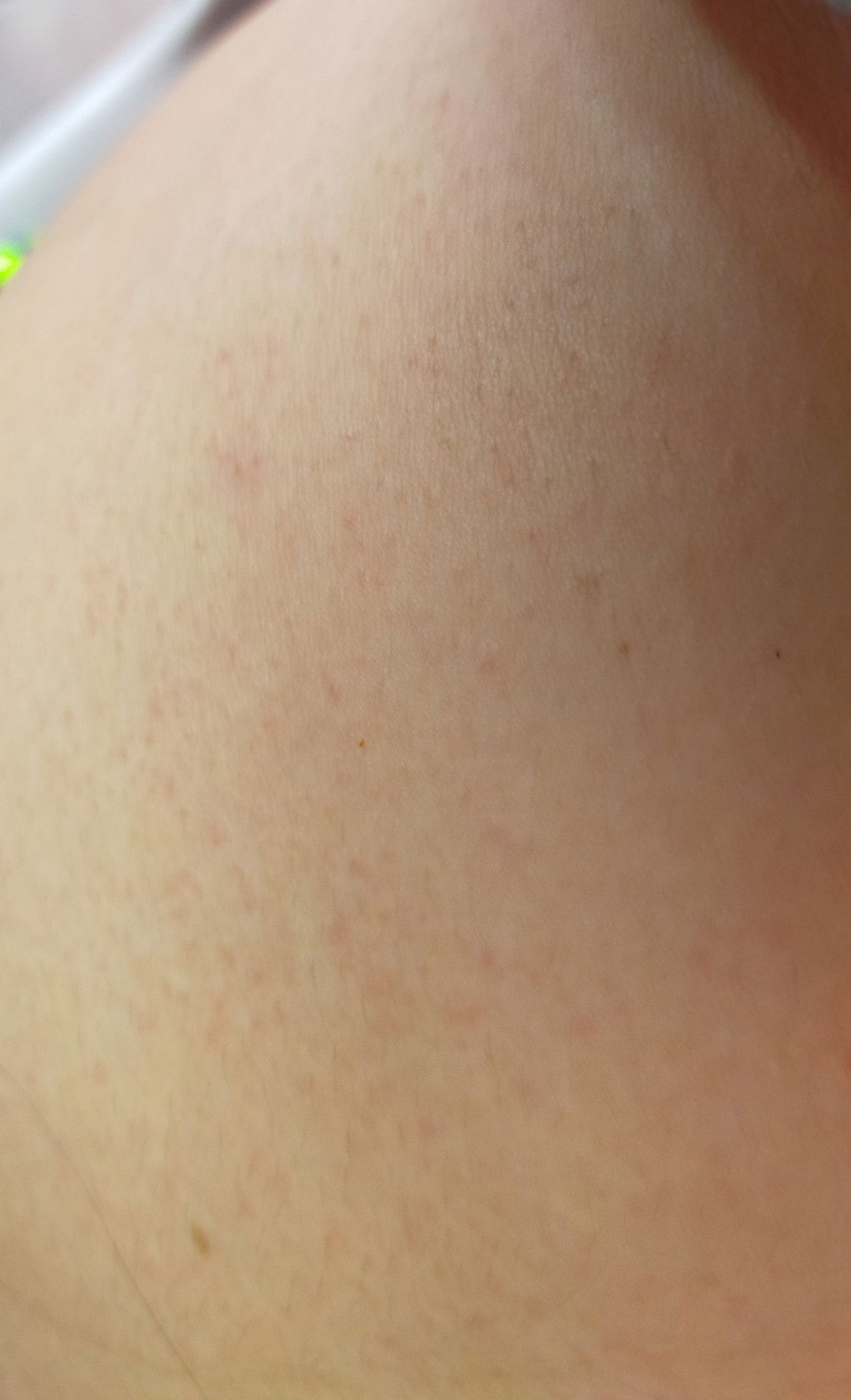 Heat Rashes on my baby bump?