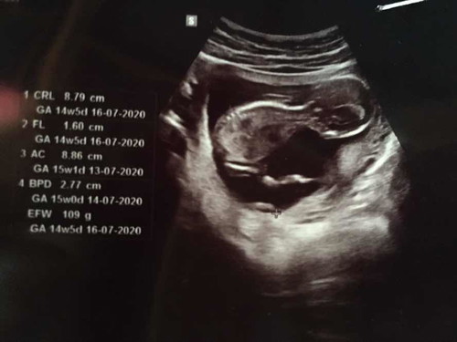 15w+5แล้วค่ะ แม่ๆรู้เพศน้องสัปดาห์ที่เท่าไหร่กันค่ะ