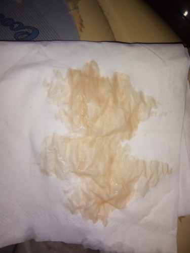 Kecoklatan di hamil muda