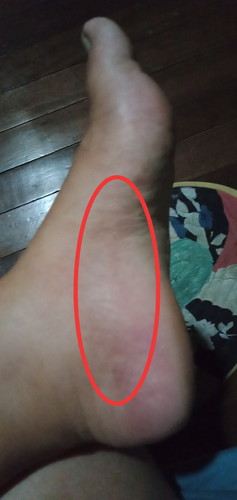 Makati sa gilid ng talampakan