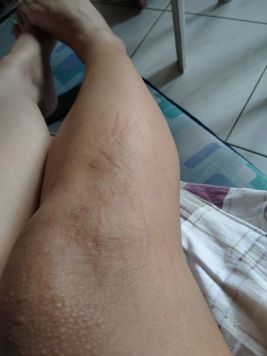 Rashes after giving birth
