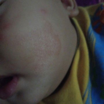 kulit pipi kemerahan