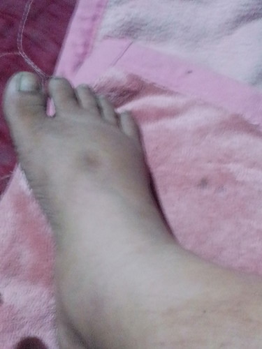 อาการเท้าบวม