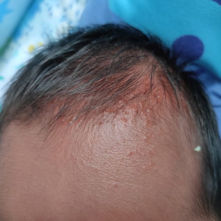 สอบถามค่ะ ลูกมีผื่นแบบนี้