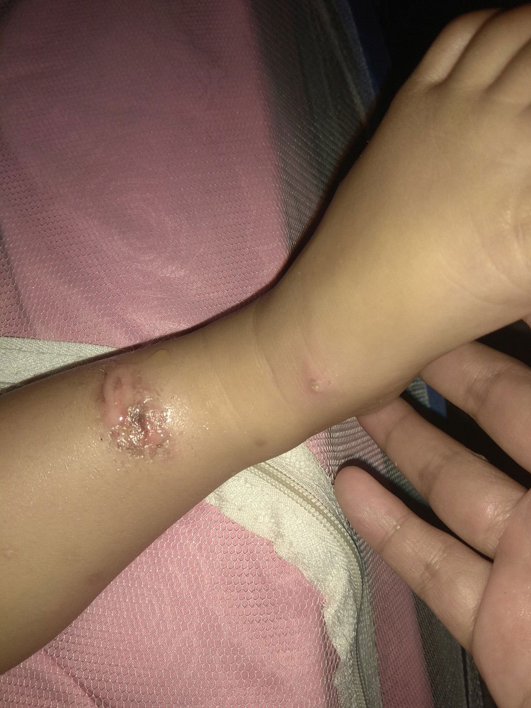 obat utk luka pada anak