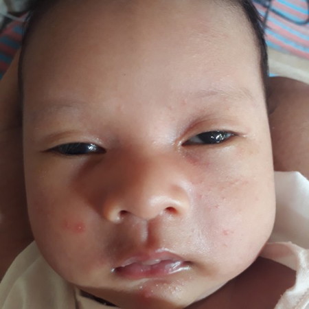 ผื่นขึ้นหน้า