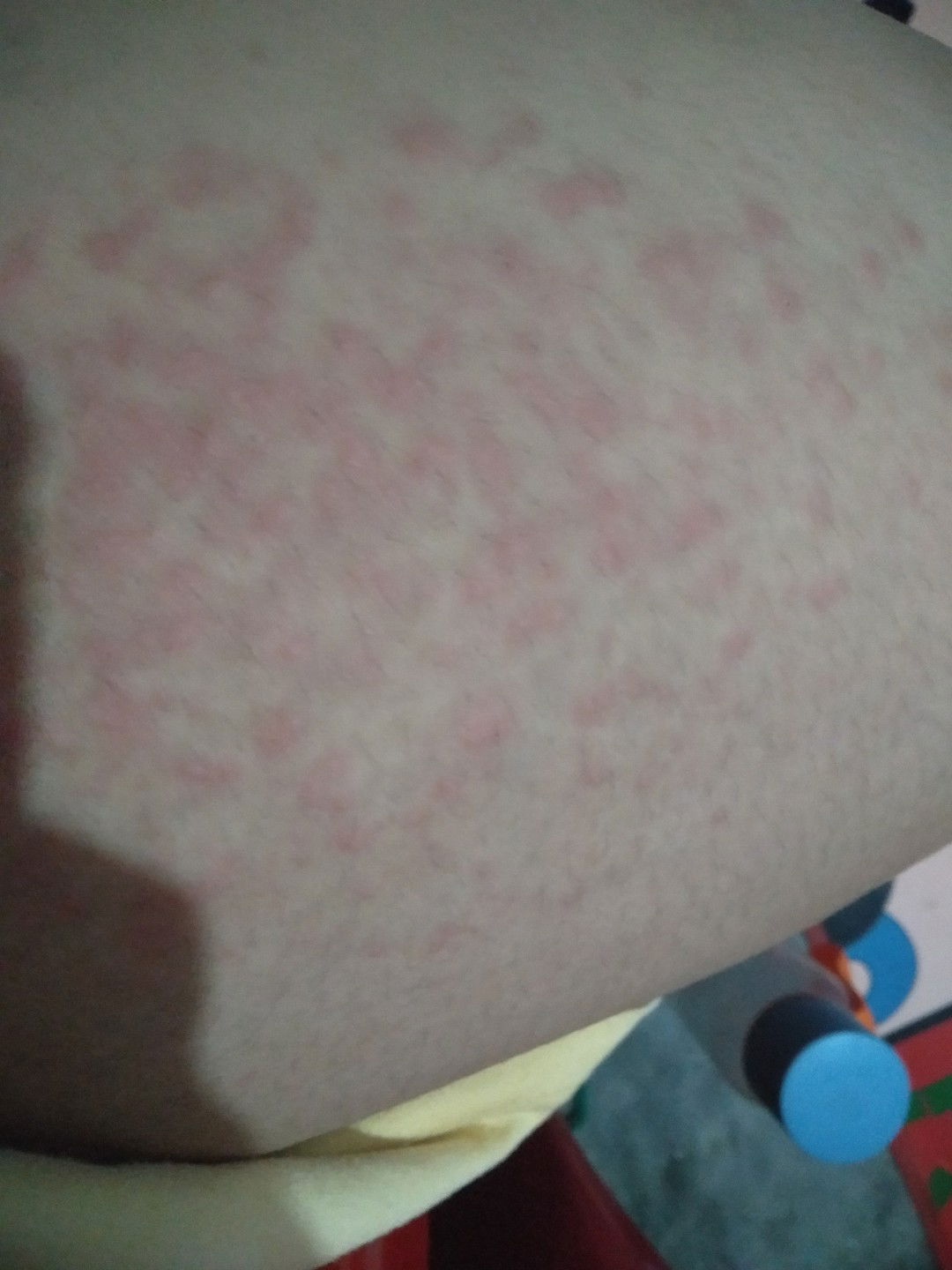 gatal-gatal saat hamil