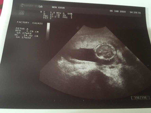 อัลตราซาวด์ครั้งแรก