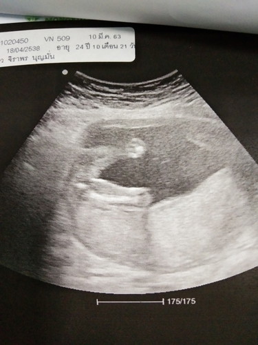 เสี่ยงมดลูกแตก